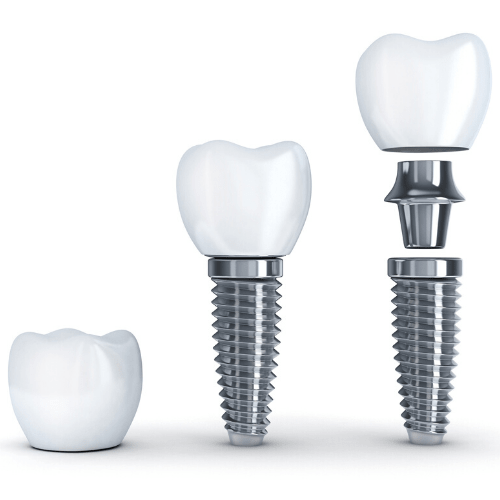 Dental Implants